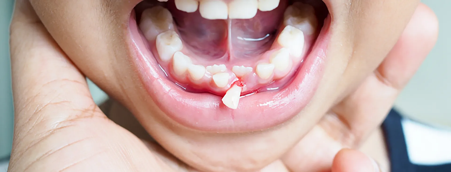 Dijete pokazuje ispali mliječni zub – početak ortodontskog razvoja